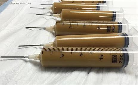 Preparación de las heces y formas de administración Heces frescas (50-100 g) /congeladas (banco muestras) Diluídas, homegeneizadas, filtradas (500 ml) Instilación: colonoscopia, enema, cápsules