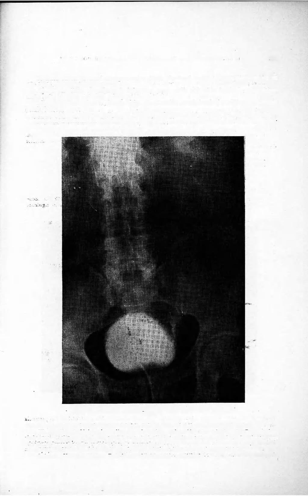 TUMORES PRIMITIVOS DE URETER 151 Presenta en sus antecedentes personales úlcera duodenal tratada quirúrgicamente en el año 1948 y eventración postoperatoria.
