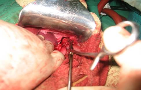 izquierda con presencia del ángulo esplénico del colon en el hemitórax homolateral. La paciente fue traslada al Servicio de Cirugía General, donde fue operada de forma electiva.