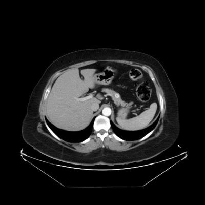41 Figura 1: Figura 1. Metástasis pancreática secundaria a carcinoma renal. 137 Figura 2: Figura 2.