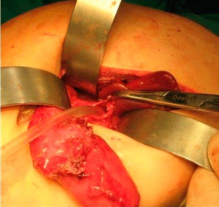 Se decidió realizar laparotomía a través de incisión media supraumbilical para liberar y disecar el estómago, con la mayor irrigación posible del órgano (fig. 2).