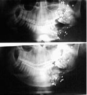 radica en la dificultad de apertura de la cavidad oral, en relación con la lesión grave del cuerpo y rama ascendente del maxilar inferior, considerando además que se