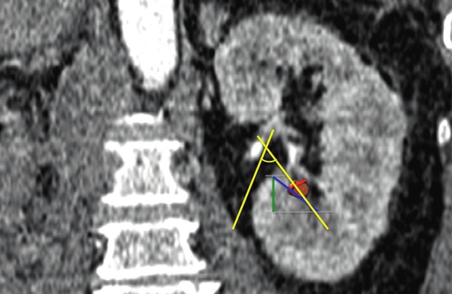 Determinantes anatómicas del polo inferior para la resolución de litos con ureteroscopia 161 flexible.