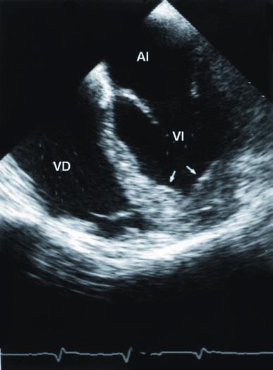Manual de Ecocardiografía Figura 4. Miocardiopatía hipertrófica apical visto por ecocardiografía transesofágica. Las flechas marcan el aumento del espesor del miocardio izquierdo a nivel apical.