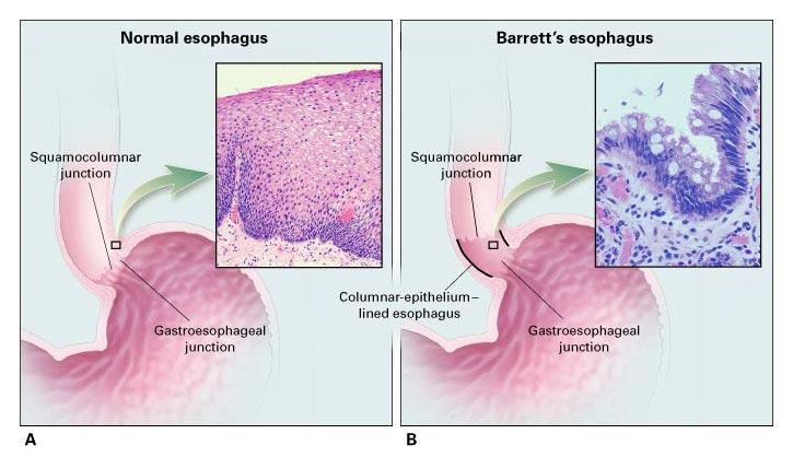 Metaplasia de Barrett del esófago sustitución