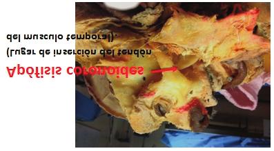Adosado a la cara anterior del haz esfenoidal se encuentra la arteria maxilar interna, la cual se disecó retirando la porción de aponeurosis interpterigoidea que la