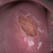Cervix normal Infección