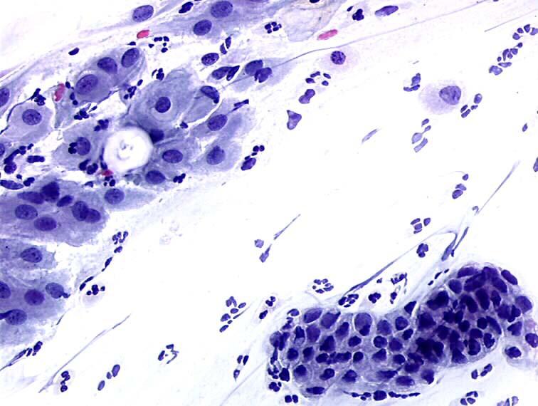placa de células metaplásicas maduras y grupo de células