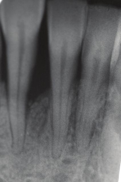 Caso clínico Tratamiento de un defecto periodontal en la