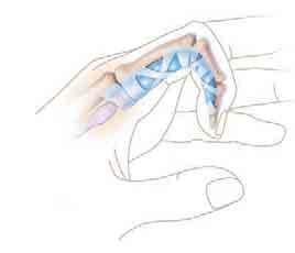 Los tendones inflamados también pueden ejercer presión sobre los nervios y provocar cosquilleo o entumecimiento.
