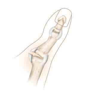 Esguinces y dislocaciones Un golpe o una caída fuerte sobre la mano puede estirar o desgarrar los ligamentos que conectan los huesos, lo cual puede ocasionar un esguince o una dislocación.