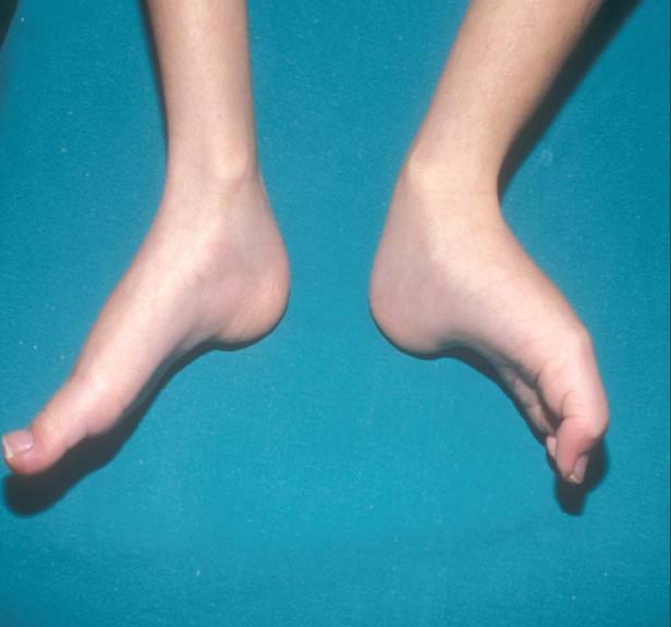 2 PIE CAVO Referencia: Deformidades del pie (Jesús Muñoz) Departamento