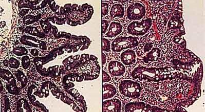 Hematoxilina-eosina de las vellosidades intestinales: el epitelio normal (izquierda) y el epitelio celíaco (derecha), que se