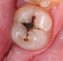 ANTECEDENTES Caries dental, principal problema Eric Reynolds Fosfopéptido de