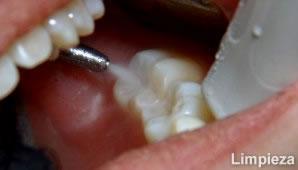 5 Disminuyó la progresión y promovió la regresión de caries dental Lesiones