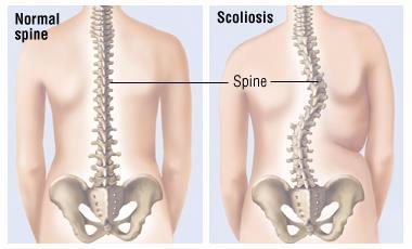 Análisis de oscilaciones posturales en la escoliosis La escoliosis, o curvatura anormal de la columna vertebral, afecta aproximadamente al