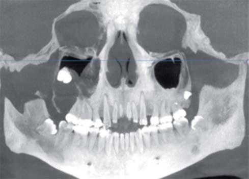 de los dientes involucrados. La imagen radiográfica de la mayoría se asemeja a la del ameloblastoma.