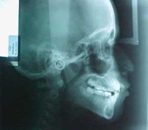 Página 5 Fig 7 Radiografía lateral de cráneo Objetivos del tratamiento: Corregir apiñamiento maxilar y mandibular, incorporar el incisivo central superior izquierdo al arco, esto mediante una ventana