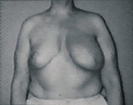 366 Cuadro 5. Reconstrucción mamaria inmediata con colgajo TRAM. tracturas o de infección, que se ve también asociada a radioterapia.