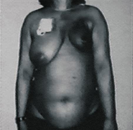 367 Cuadro 7. Cáncer de mama recurrente. sobre la mama reconstruida en el posoperatorio.