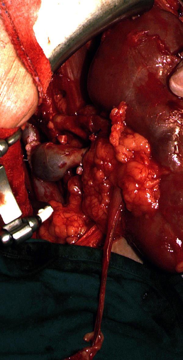 Trasplante Renal COMPLICACIONES POTENCIALES (1-5%) Incisión quirúrgica