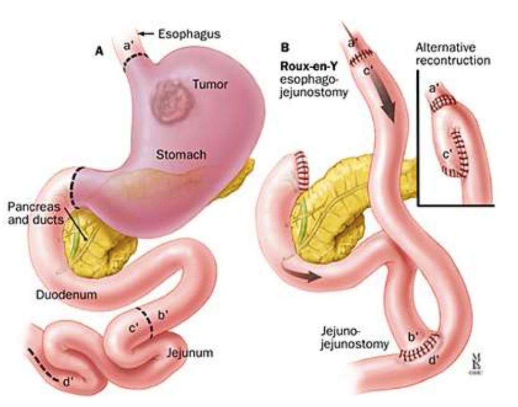 Cirugía Profiláctica Gastrectomía: técnica Gastrectomía con reconstrucción Y de Roux+D1 No justificado D2 por las