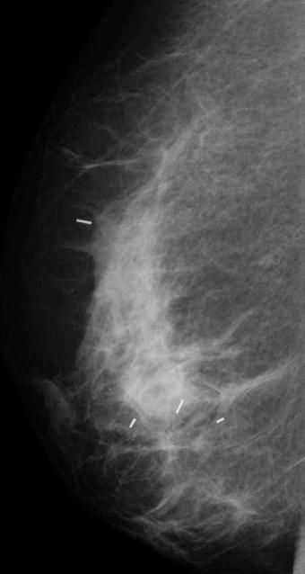 Métodos de Valoración de Respuesta Métodos Tradicionales (EF, mamografía, ecografía) Limitados en el ddx fibrosis residual-tumor