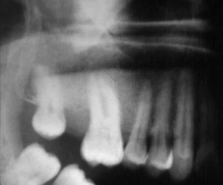 D Figura 1 DF Monostótica en maxilar superior,