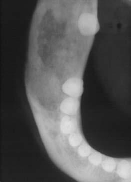 dentario. : Rx oclusal muestra deformación ósea hacia vestibular.