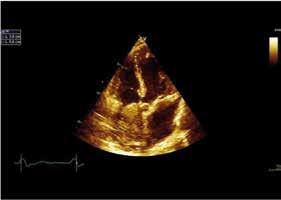 En ecocardiograma de control se observa masa intraauricular derecha, por lo que es trasladado el 25 de abril de 2014 al Servicio de Cardiología del Hospital Clínico San Borja Arriarán (HCSBA) para