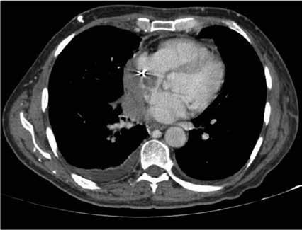 derechas, hiliares derechas y subcarinales. Además, se visualizaban lesiones sospechosas de metástasis en lóbulo inferior derecho de pulmón y en hígado.