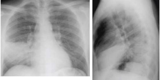 Radiología: La radiografía de tórax se debe considerar obligatoria en pacientes con sospecha de NAC Confirmar el diagnóstico de NAC, descartar diagnósticos