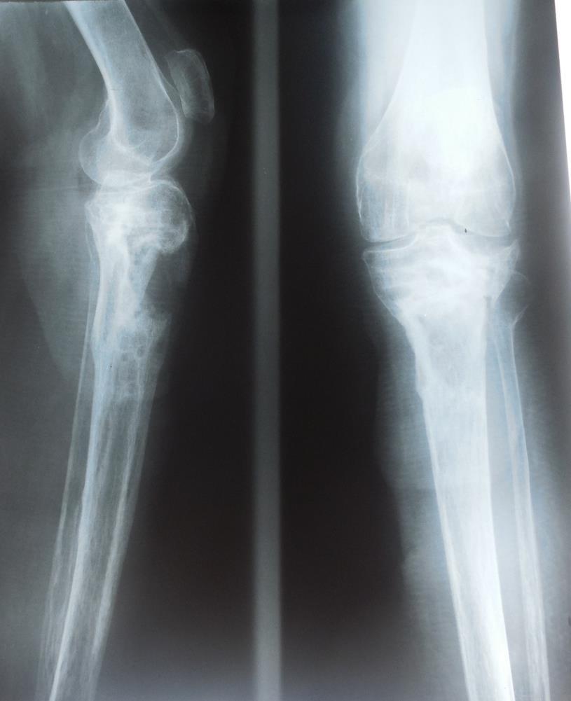 Evolución Presentó mala evolución de la herida quirúrgica infectada, en 2007 se retiró el material de osteosíntesis, completando tratamiento ATB según cultivo de partes blandas.