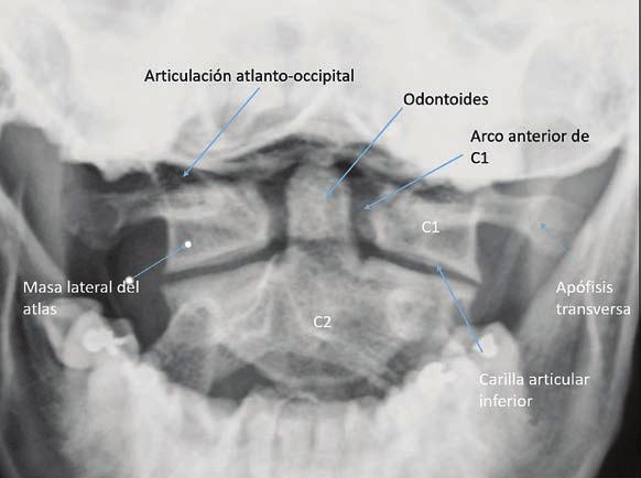 En las masas laterales se encuentran las carillas articulares superiores, con una forma cóncava que permite que se articulen con los cóndilos, formando la articulación atlanto-occipital que