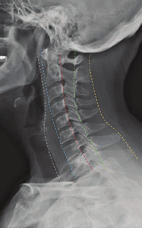 Rev.Medica.Sanitas 21 (1): 39-46, 2018 FIGURA 4. Radiografía lateral de la columna cervical que muestra las líneas espinales.