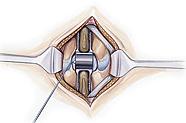 4. Inserción del implante El implante se impacta utilizando un martillo.