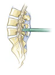 En caso de la reconstrucción del ligamento una figura de 8 la suturas a traves de dos agujeros del hueso en el proceso espinoso y a través del ligamento supraspinoso.