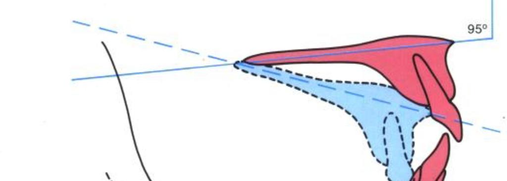 El ángulo de inclinación se reduce en caso de desplazamiento posterior del maxilar superior.