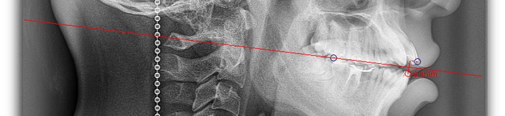 Para ello se utilizó los puntos cefalométricos: Nasion (N), Espina nasal