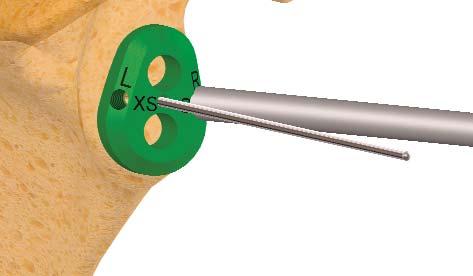 TÉCNICA QUIRÚRGICA - GLENOIDES Colocación de la aguja: Coloque una de las dos plantillas guías sobre la