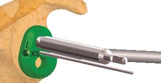 Escariador verde = implante XS o S. Escariador naranja = implante M o L.