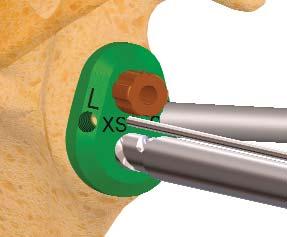 4 Implante de prueba: Inserte el implante de prueba sirviéndose de la pinza portaglenoides.