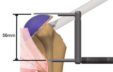 Nivele el trocar con el punto de inserción del fascículo clavicular del músculo pectoral mayor.