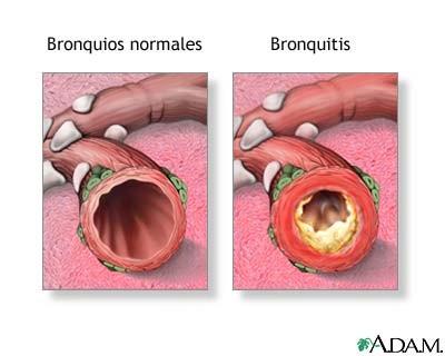 Bronquitis: inflamació de la