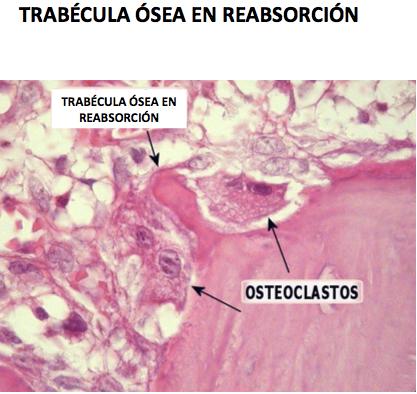Forma estrellada - Los osteoclastos plurinucleados, más grandes y tiene una cara ondulada por donde está degradando el hueso.