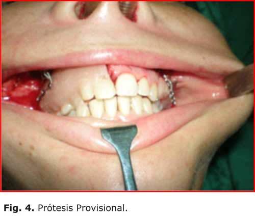 Diagnóstico histopatológico: Mixoma odontogénico.