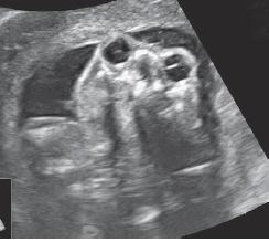 alton M, Gratacós E. Obstetric Imaging.
