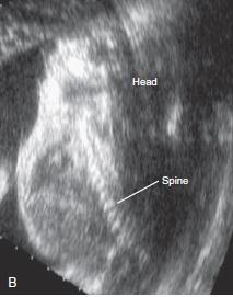 Ausencia de cuello, con retroflexión de cabeza Acortamiento espinal Vértebras cervicales mal diferenciadas, falta de cierre posterior Iniencefalia
