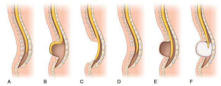 Espina bífida Clasificación Normal Abierta Cerrada