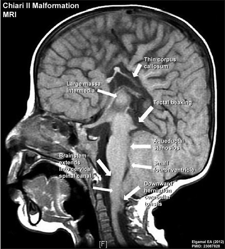 Espina bífida abierta Fisiopatología Falla en cierre de neuroporo caudal Impide acumulación de LCR en vesícula romboencefálica, ausencia de dilatación fisiológica Fosa posterior pequeña Hernia de